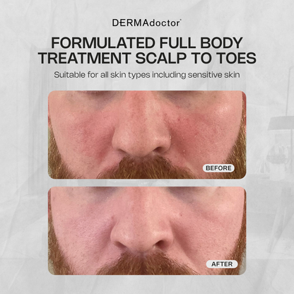Calm Cool &amp; Corrected Tranquility Cleanser for Seborrheic Dermatitis &amp; Dandruff