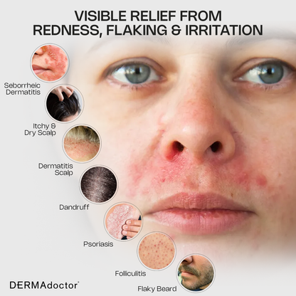 Calm Cool &amp; Corrected Tranquility Cleanser for Seborrheic Dermatitis &amp; Dandruff