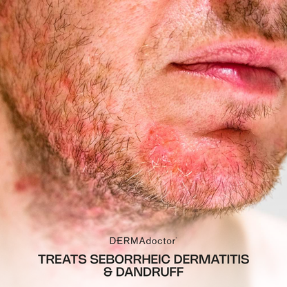 Calm Cool &amp; Corrected Tranquility Cleanser for Seborrheic Dermatitis &amp; Dandruff