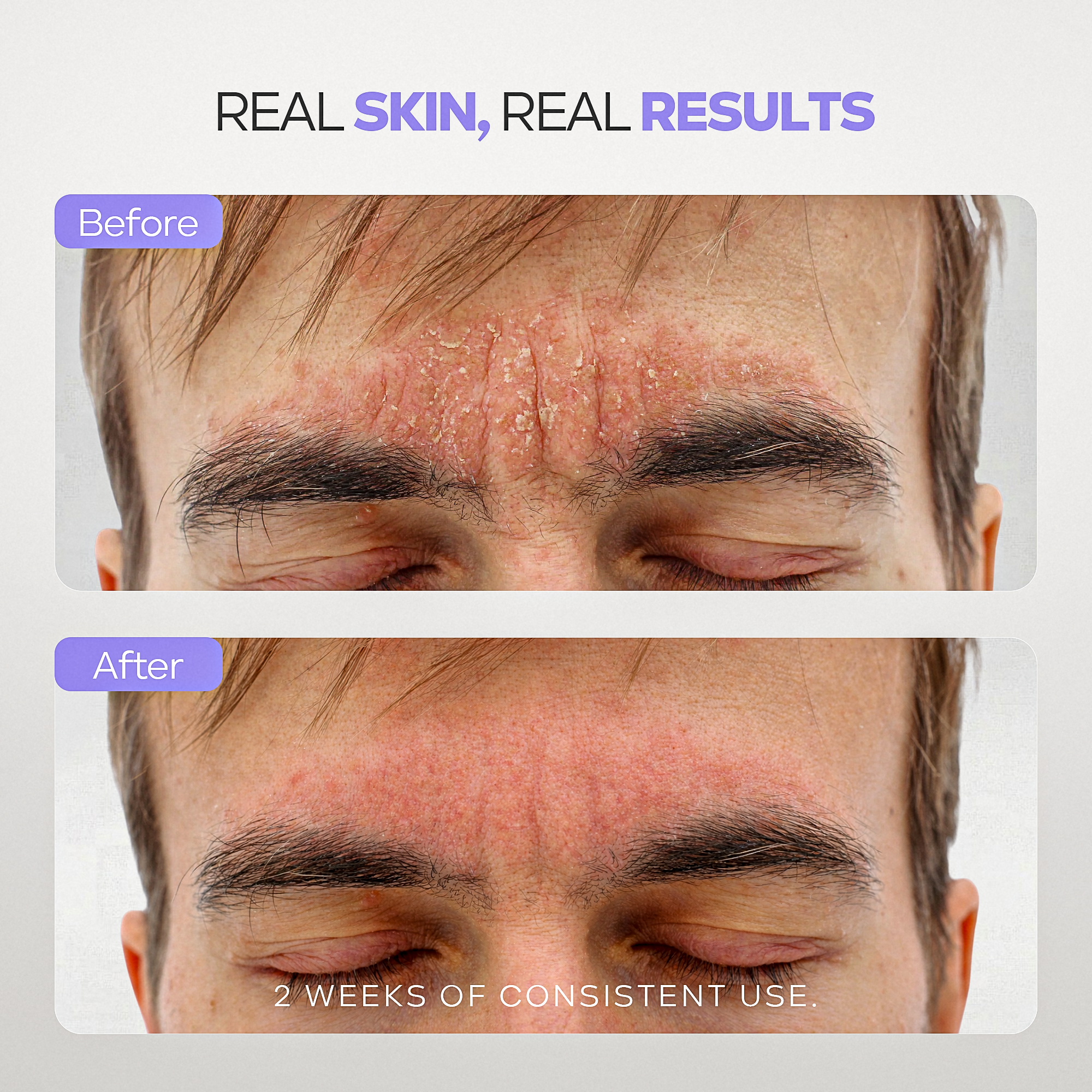 Calm Cool &amp; Corrected Tranquility Cleanser for Seborrheic Dermatitis &amp; Dandruff