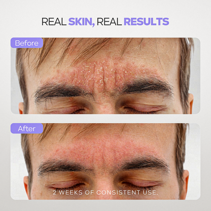 Calm Cool &amp; Corrected Tranquility Cleanser for Seborrheic Dermatitis &amp; Dandruff