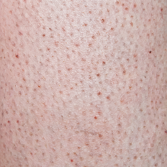 Keratosis Pilaris